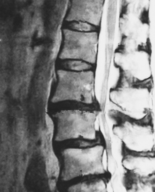 腰椎のMRI写真